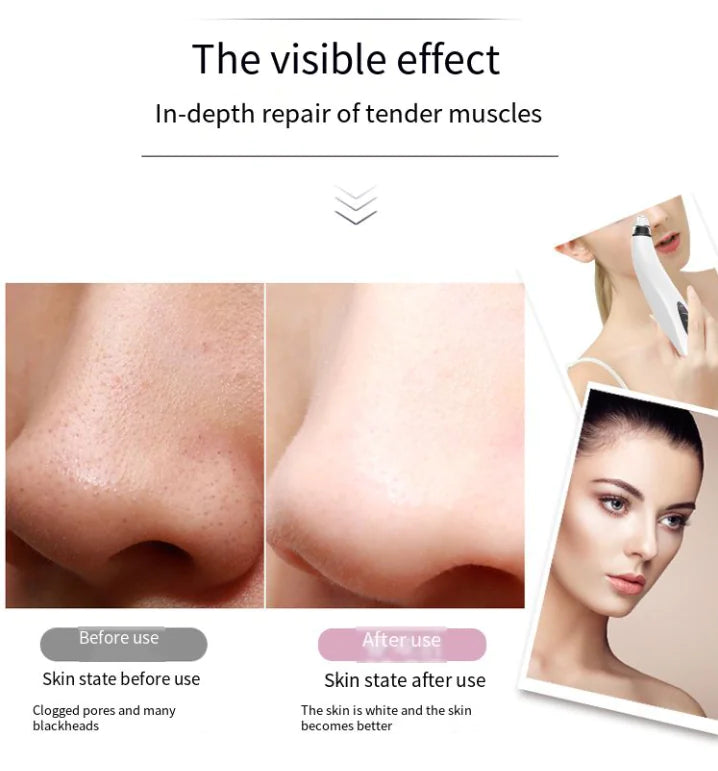 IcyAura™ Pore Extractor